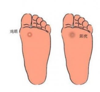 ​跖疣和鸡眼傻傻分不清楚？皮肤科医生教你几招辨别