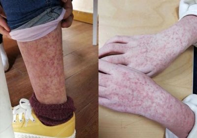 ​紫癜是什么病？多种紫癜类型，你了解全了吗？