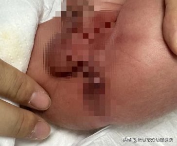 关爱出生缺陷,给宝宝无限未来——肛门闭锁患儿的“闯关大作战”